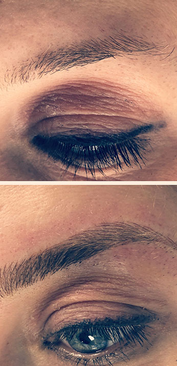 Brow transformation